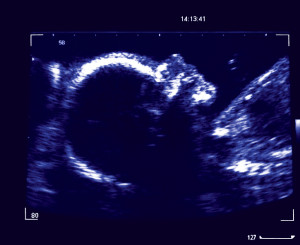 A scan of an ultrasound image of a 26 week old fetus